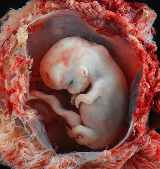 aborted-fetus-8-weeks